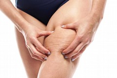 Cellulite: prevenzione, stile di vita e trattamenti