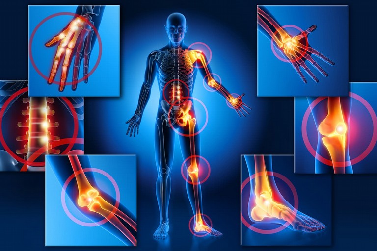 Fibromialgia